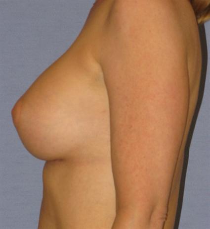 Breast Augmentation Before & After Patient #914