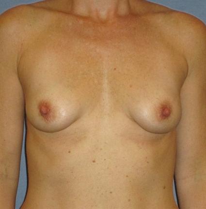 Breast Augmentation Before & After Patient #909