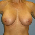 Breast Augmentation Before & After Patient #909