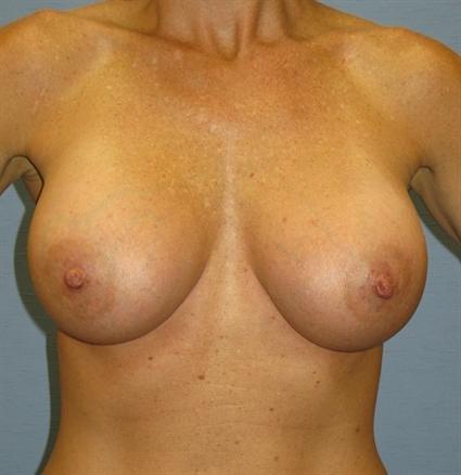 Breast Augmentation Before & After Patient #909