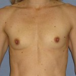 Breast Augmentation Before & After Patient #902