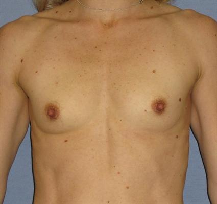 Breast Augmentation Before & After Patient #902