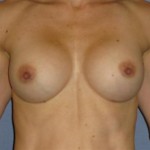 Breast Augmentation Before & After Patient #902