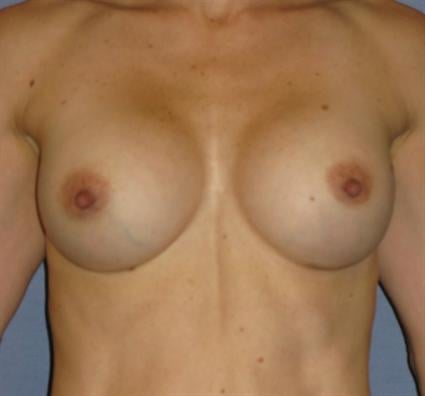 Breast Augmentation Before & After Patient #902