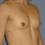 Breast Augmentation Before & After Patient #902