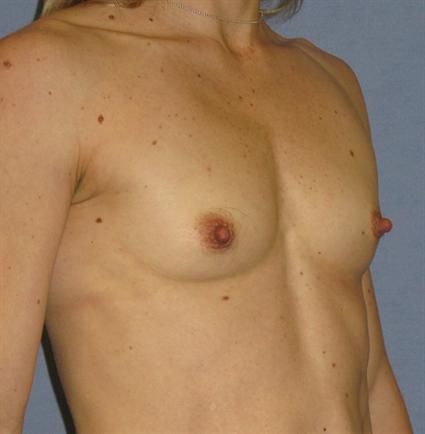 Breast Augmentation Before & After Patient #902