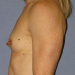 Breast Augmentation Before & After Patient #902