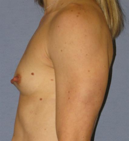 Breast Augmentation Before & After Patient #902