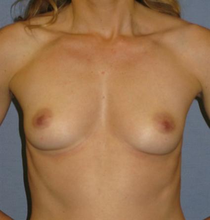 Breast Augmentation Before & After Patient #895