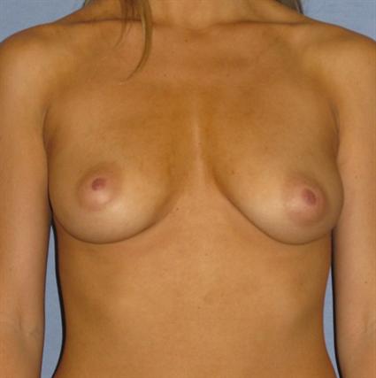 Breast Augmentation Before & After Patient #888
