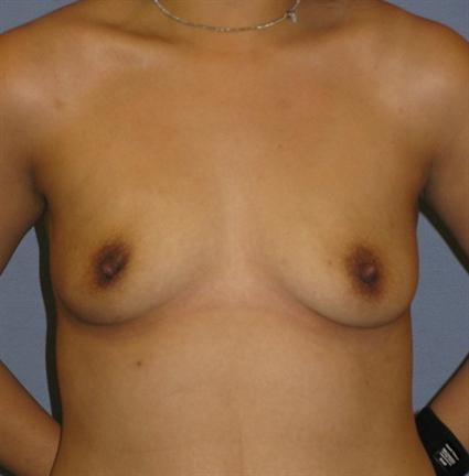 Breast Augmentation Before & After Patient #881