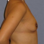 Breast Augmentation Before & After Patient #881