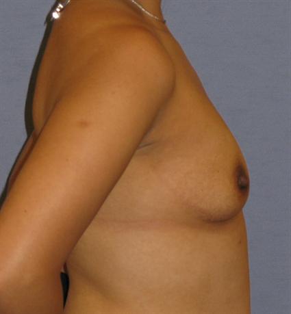 Breast Augmentation Before & After Patient #881