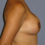 Breast Augmentation Before & After Patient #881