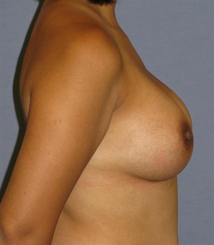 Breast Augmentation Before & After Patient #881