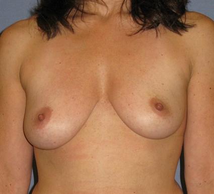 Breast Augmentation Before & After Patient #874