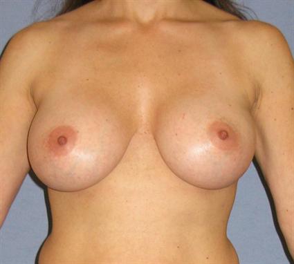 Breast Augmentation Before & After Patient #874