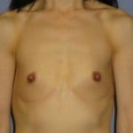 Breast Augmentation Before & After Patient #871