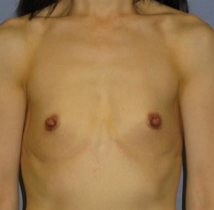 Breast Augmentation Before & After Patient #871