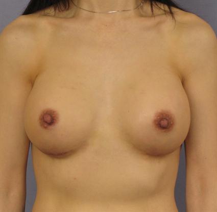 Breast Augmentation Before & After Patient #871