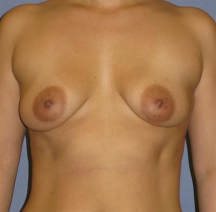 Breast Augmentation Before & After Patient #864