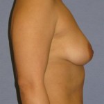 Breast Augmentation Before & After Patient #864