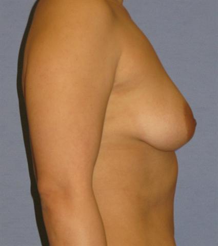 Breast Augmentation Before & After Patient #864