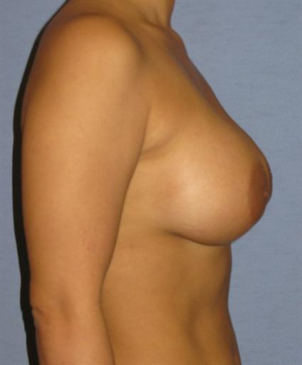 Breast Augmentation Before & After Patient #864