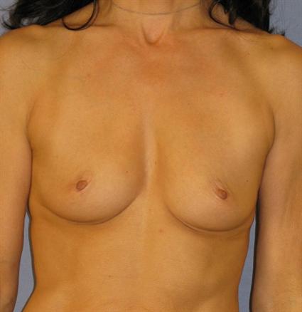 Breast Augmentation Before & After Patient #787