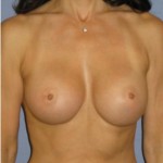 Breast Augmentation Before & After Patient #787