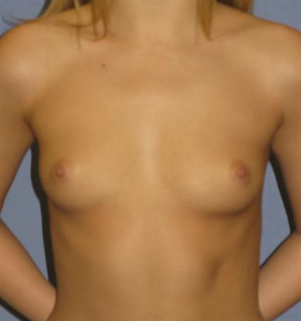 Breast Augmentation Before & After Patient #780
