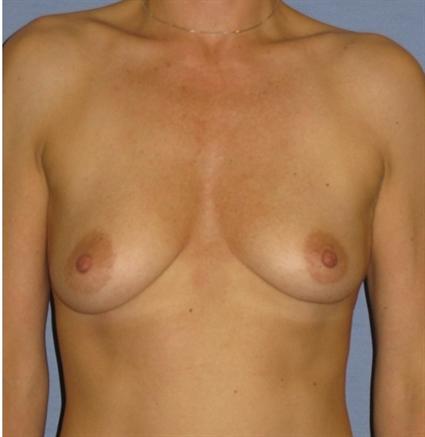 Breast Augmentation Before & After Patient #773