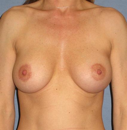 Breast Augmentation Before & After Patient #773