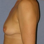 Breast Augmentation Before & After Patient #773