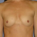 Breast Augmentation Before & After Patient #766