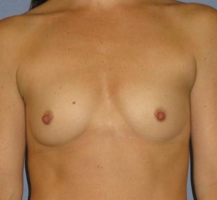 Breast Augmentation Before & After Patient #766