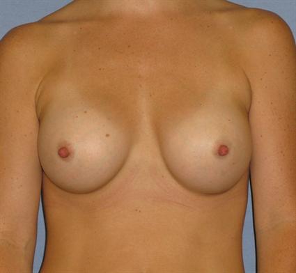 Breast Augmentation Before & After Patient #766