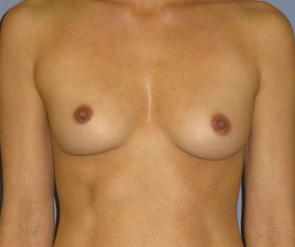 Breast Augmentation Before & After Patient #759