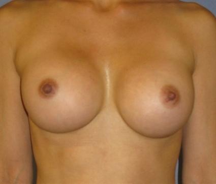 Breast Augmentation Before & After Patient #759