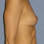 Breast Augmentation Before & After Patient #759