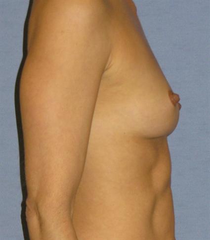 Breast Augmentation Before & After Patient #759