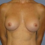 Breast Augmentation Before & After Patient #752