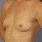 Breast Augmentation Before & After Patient #752