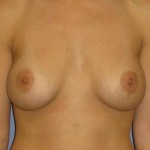 Breast Augmentation Before & After Patient #745