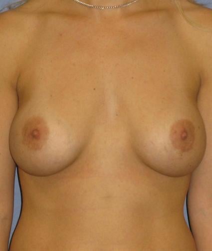 Breast Augmentation Before & After Patient #745