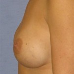 Breast Augmentation Before & After Patient #745