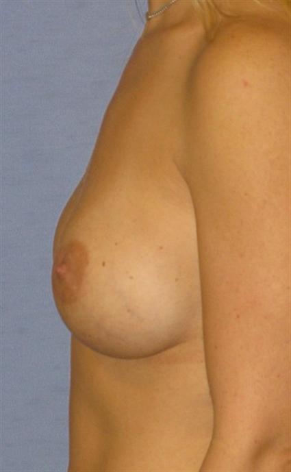 Breast Augmentation Before & After Patient #745