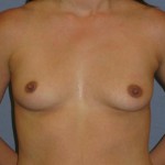 Breast Augmentation Before & After Patient #738