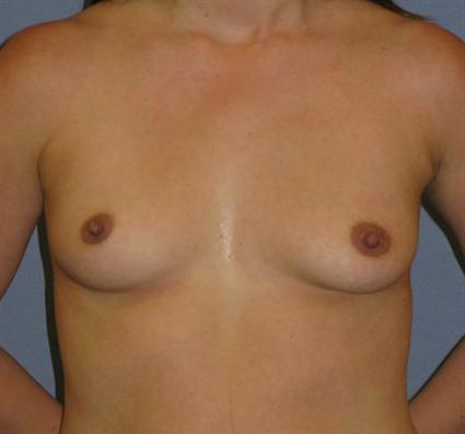 Breast Augmentation Before & After Patient #738