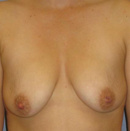 Breast Lift Before & After Patient #1371